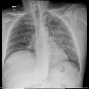 a chest x-ray that shows a more diffuse pattern of opacity