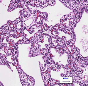 a histological slide of lung tissue with swollen alveolar septa and open airspaces