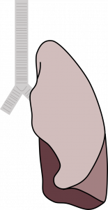 a cartoon of a lung with the lower lobe in a solid dark color (denoting infection and inflammation throughout the lobe)