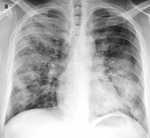 chest x-ray showing similarly distributed areas of increased opacity in the lower and middle lobes