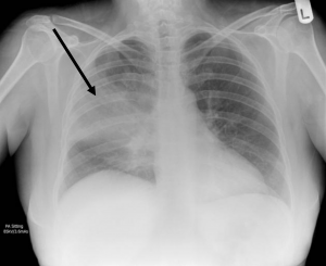 chest x-ray which show the middle lobe of the left lung having increased opacity