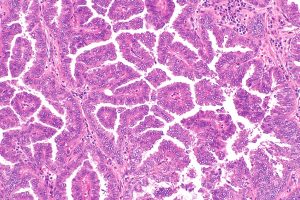 Micrograph papillary adenocarcinoma of the lung.