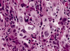 A histologic section shows a proliferation of atypical cells along the alveolar walls (A).