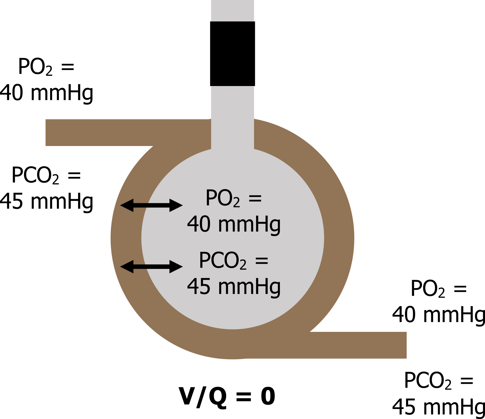 V/Q = 0. Single alveolus surrounded by only venous blood in a capillary and a block shown on the alveolar duct. Inside the alveoli shows bidirectional arrow PO2 40 mmHg and bidirectional arrow PCO2 45 mmHg. Blood at the top of the alveolus with text PO2 40 mmHg and PCO2 45 mmHg. Blood at the bottom of the alveolus with text PO2 40 mmHg and PCO2 45 mmHg