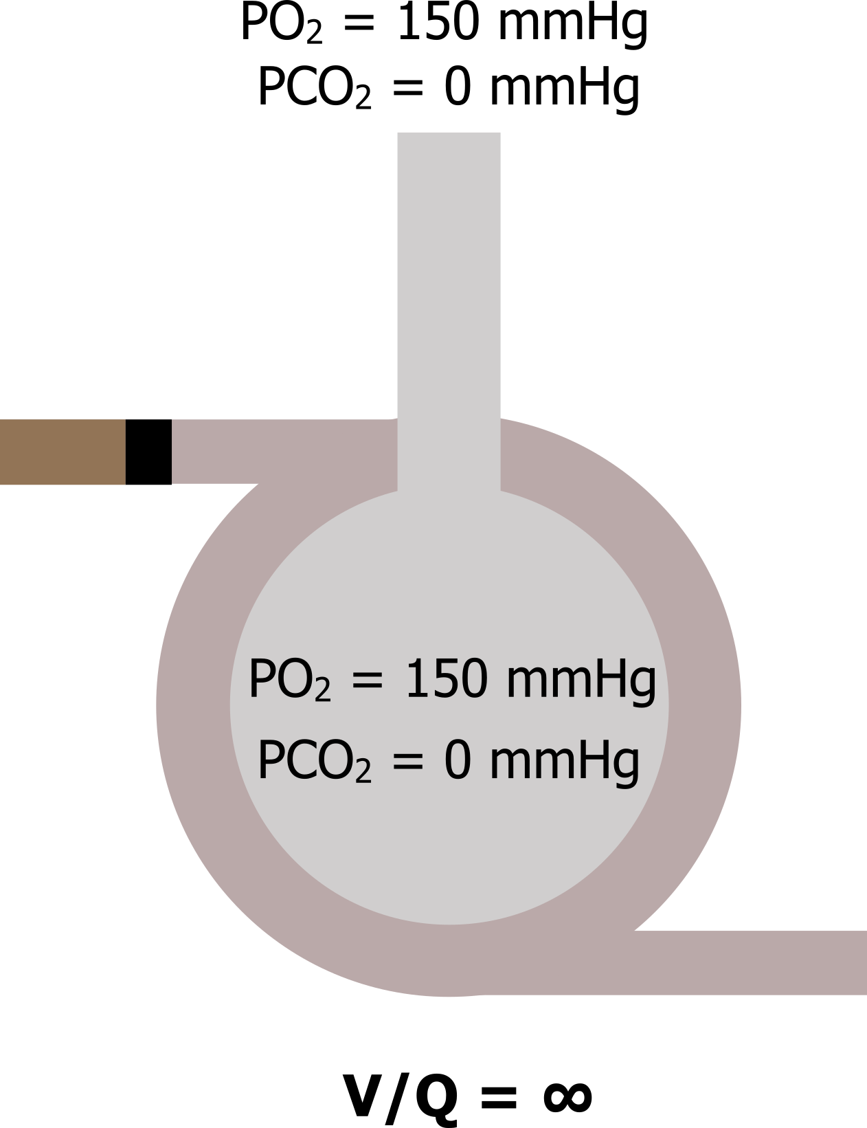 V/Q = ∞. Single alveolus with blocked blood flow in the surrounding capillary. Inside the alveoli PO2 150 mmHg and PCO2 0 mmHg. Text above the alveolar duct states PO2 = 150 mmHg and PCO2 = 0 mmHg