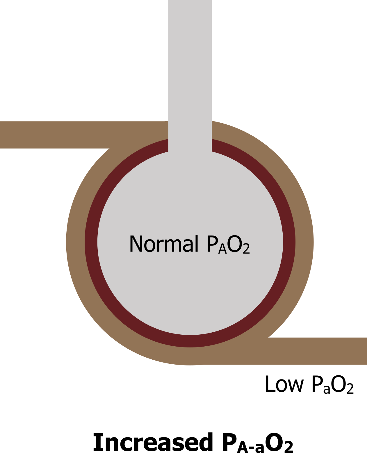 Increased PA-aO2. Alveolus with text Normal PaO2. It is surrounded by an inner dark red circle and an outer blue circle with text Low PaO2