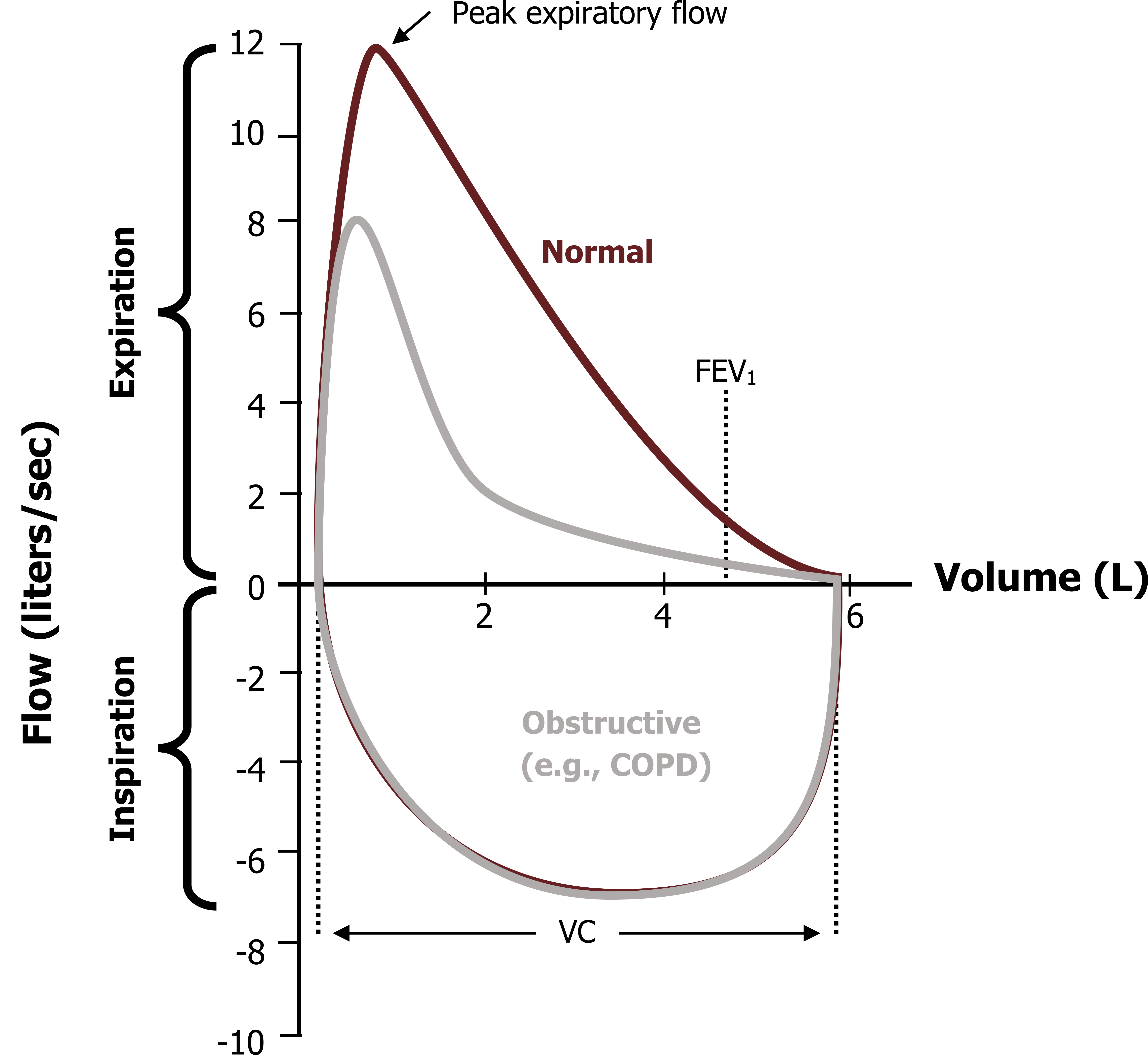 The same graph as described in figure 6.3 with an additional line labeled obstructive (e.g. COPD) which follows the same path but with a peak expiratory flow of 8 liters/second. All values are approximate.