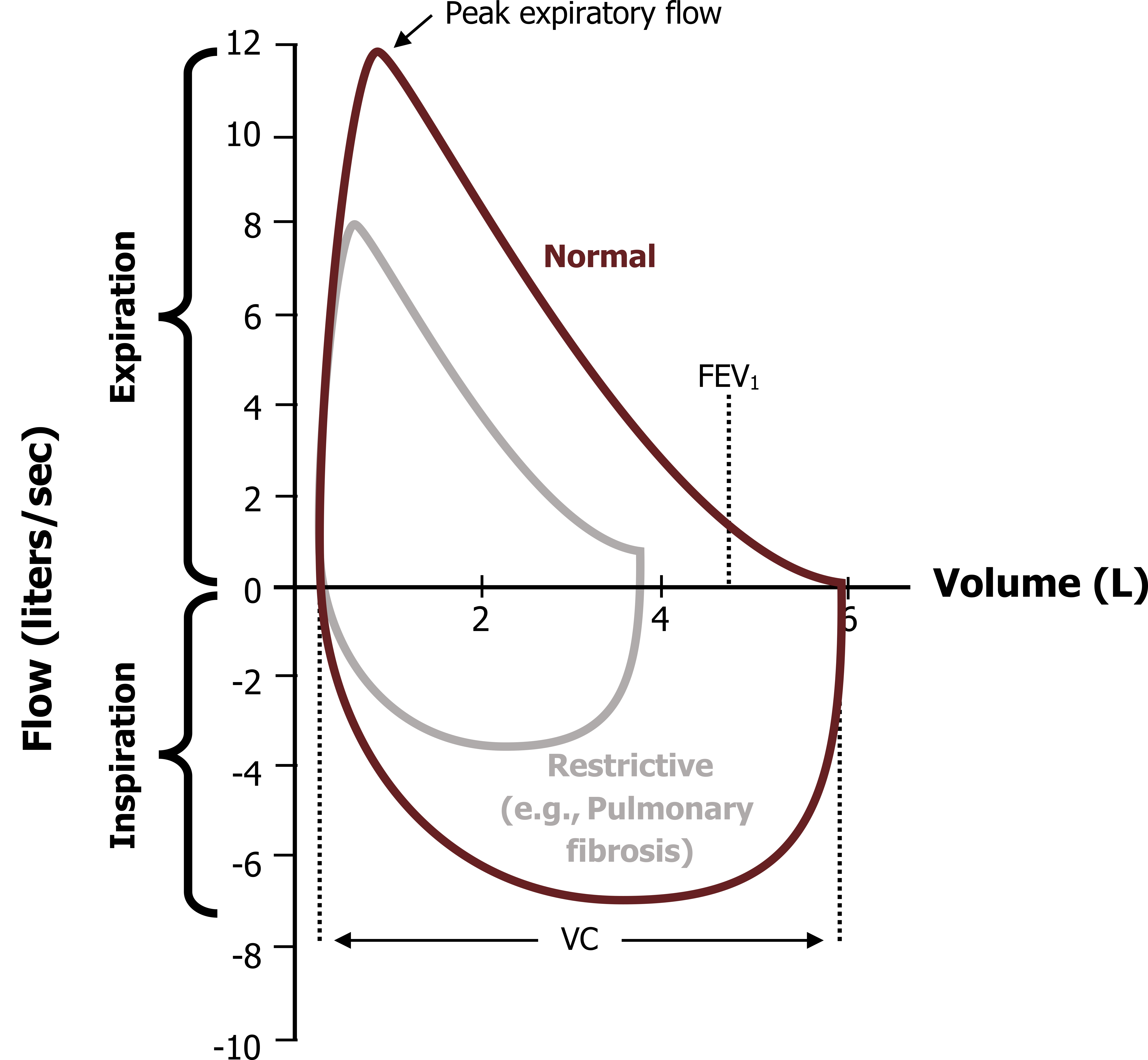 The same graph as described in figure 6.3 with an additional line labeled restrictive (e.g. Pulmonary Fibrosis). Exhalation: Begins at (0,0), peaks at (1,8) and ends at (3, 0). Inhalation: Half circular graph connecting to exhalation at (0,0) and (3,0). All values are approximate.